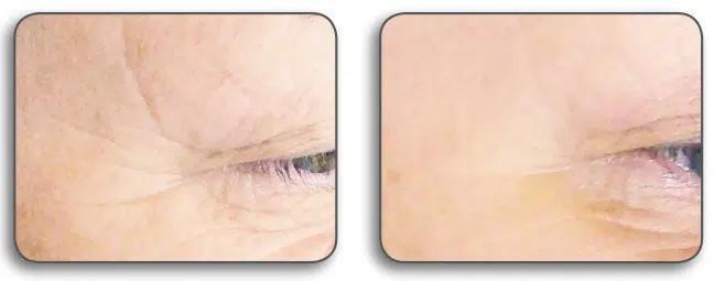 Vrásky okolo očí — pred a po