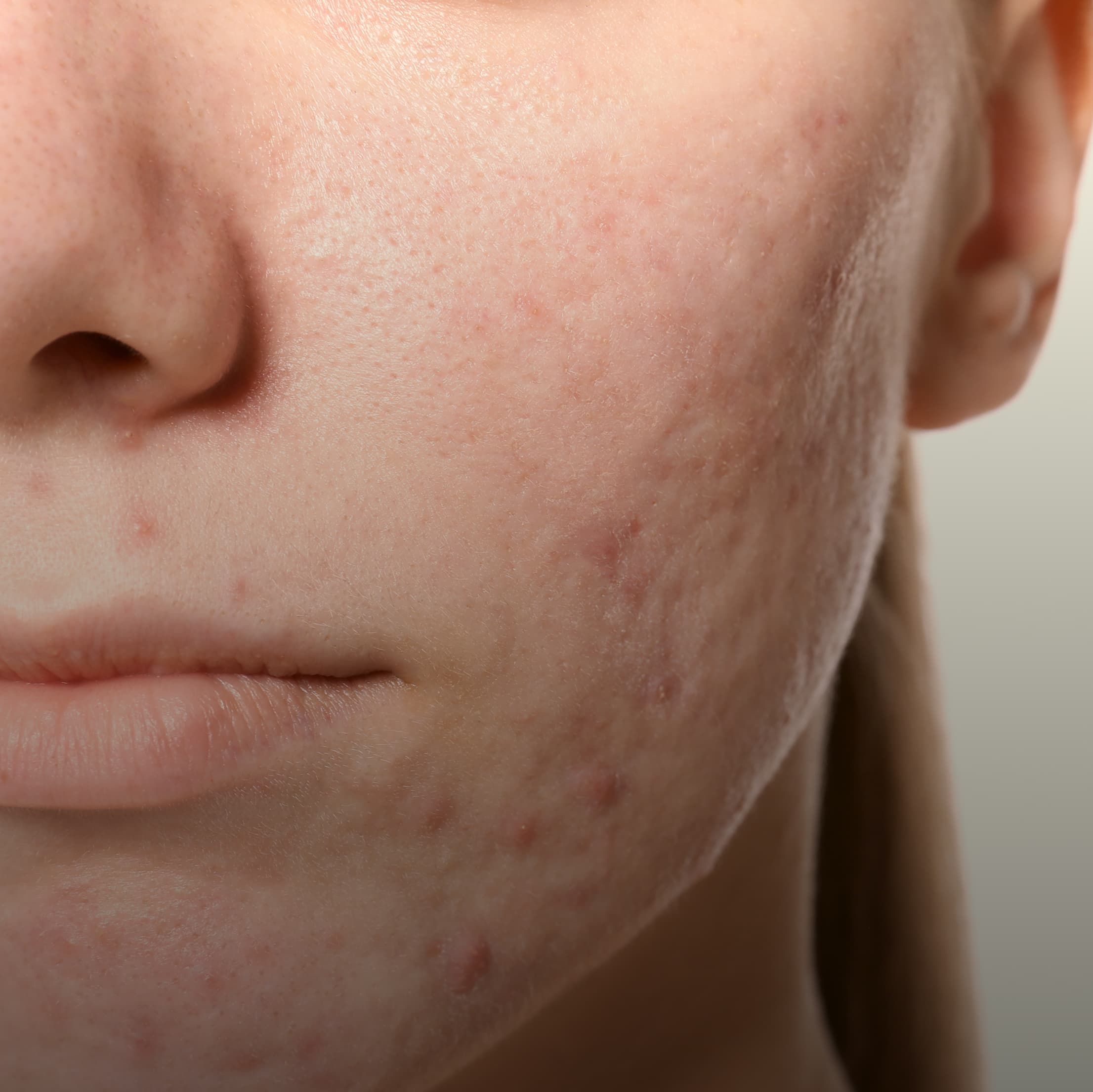 Acne Scar Treatment treatment in Burbank at NewSkinLA skincare studio