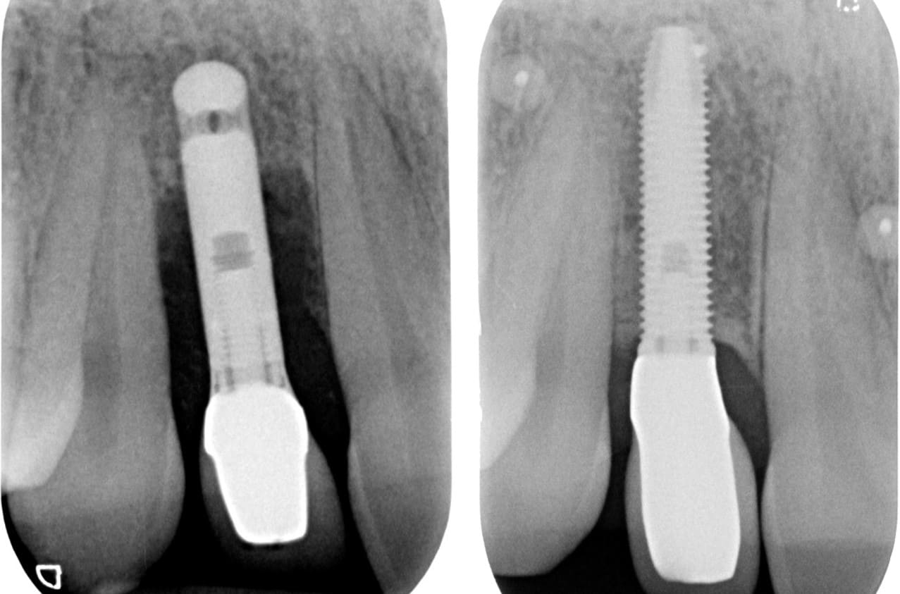 Przypadek kliniczny — kontrola RTG implantu