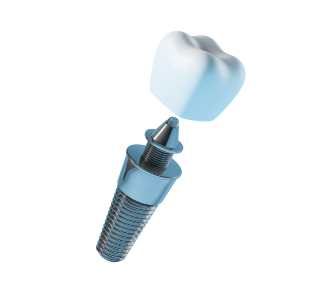 Zobu implants un kronis
