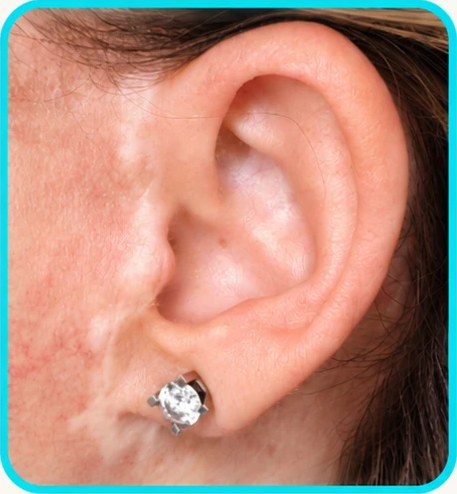 Cicatrice devant l’oreille et sous le lobe, vue rapprochée
