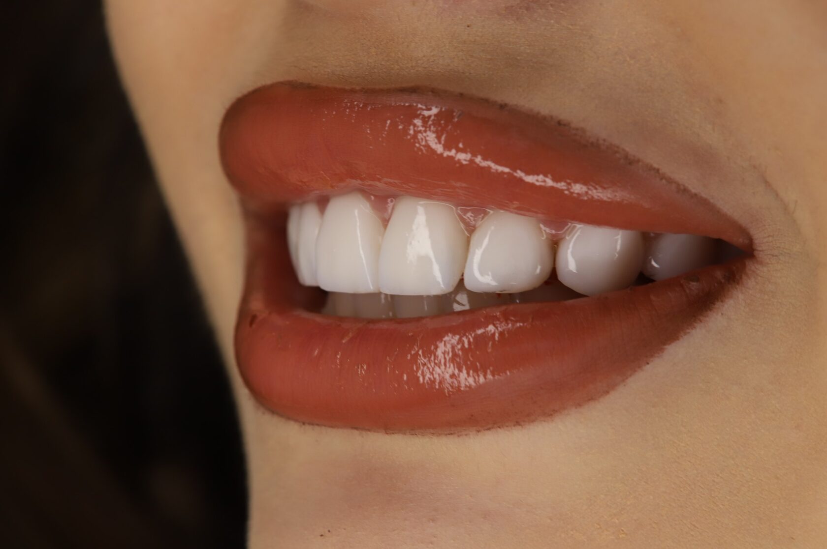 Hollywood Smile — результат лечения