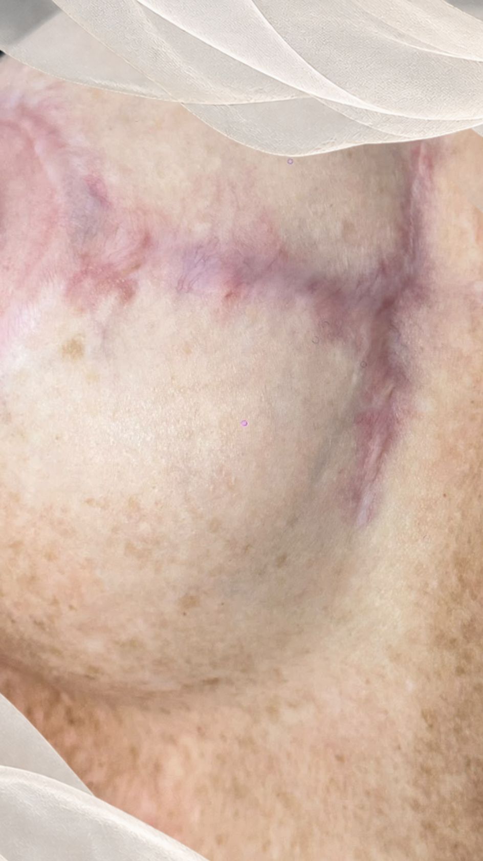 Cicatrice rouge-violacée en T sur le sein gauche, quelques mois après une opération