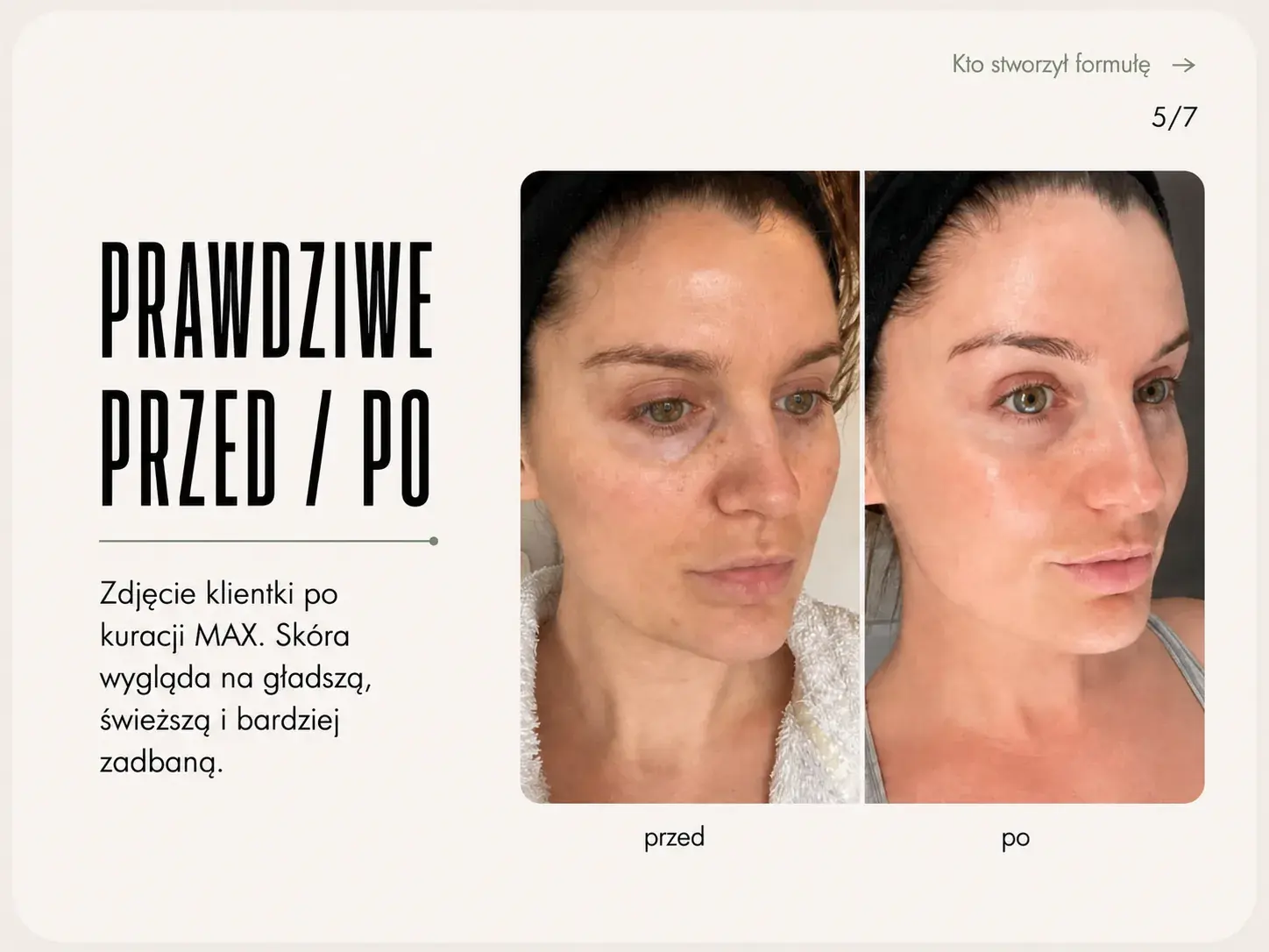 MAX lifting — przed i po kuracji