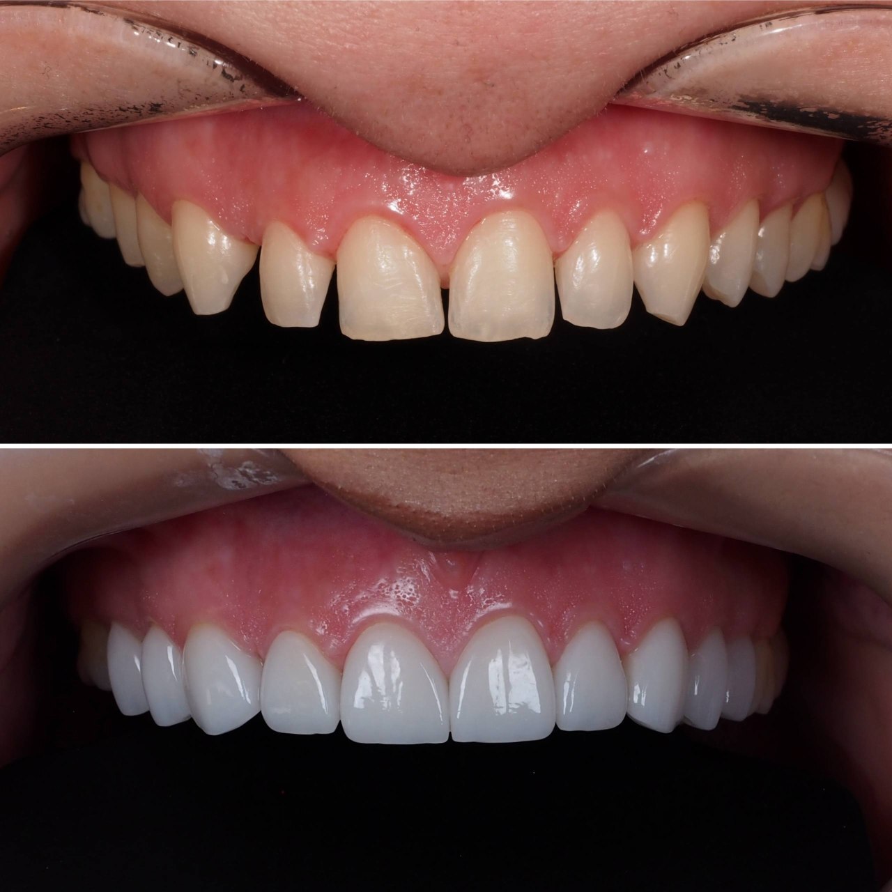Healthy dental implant crown restoration