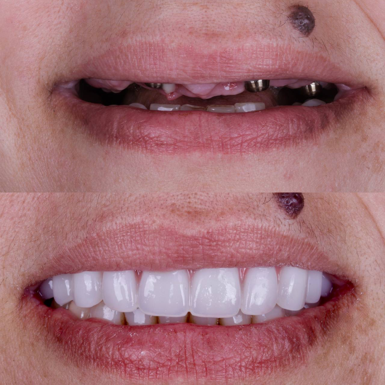Dental implant smile restoration