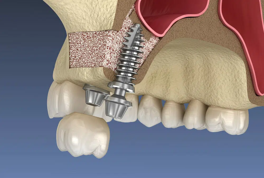 Ilustrație: implant inserat după adiție osoasă și sinus lifting