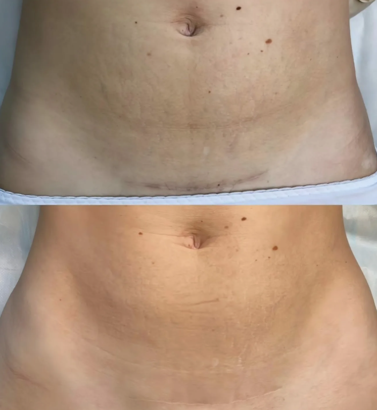 Avant / après — laser puis une séance de dermopigmentation