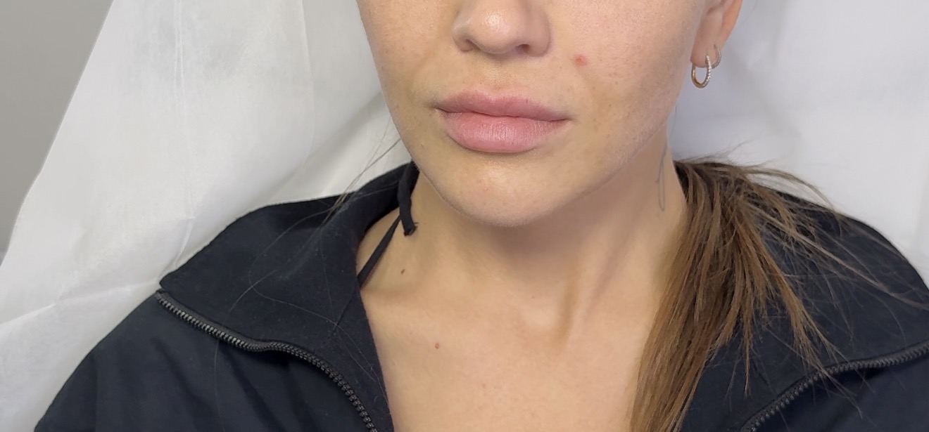 Facial Balancing Before