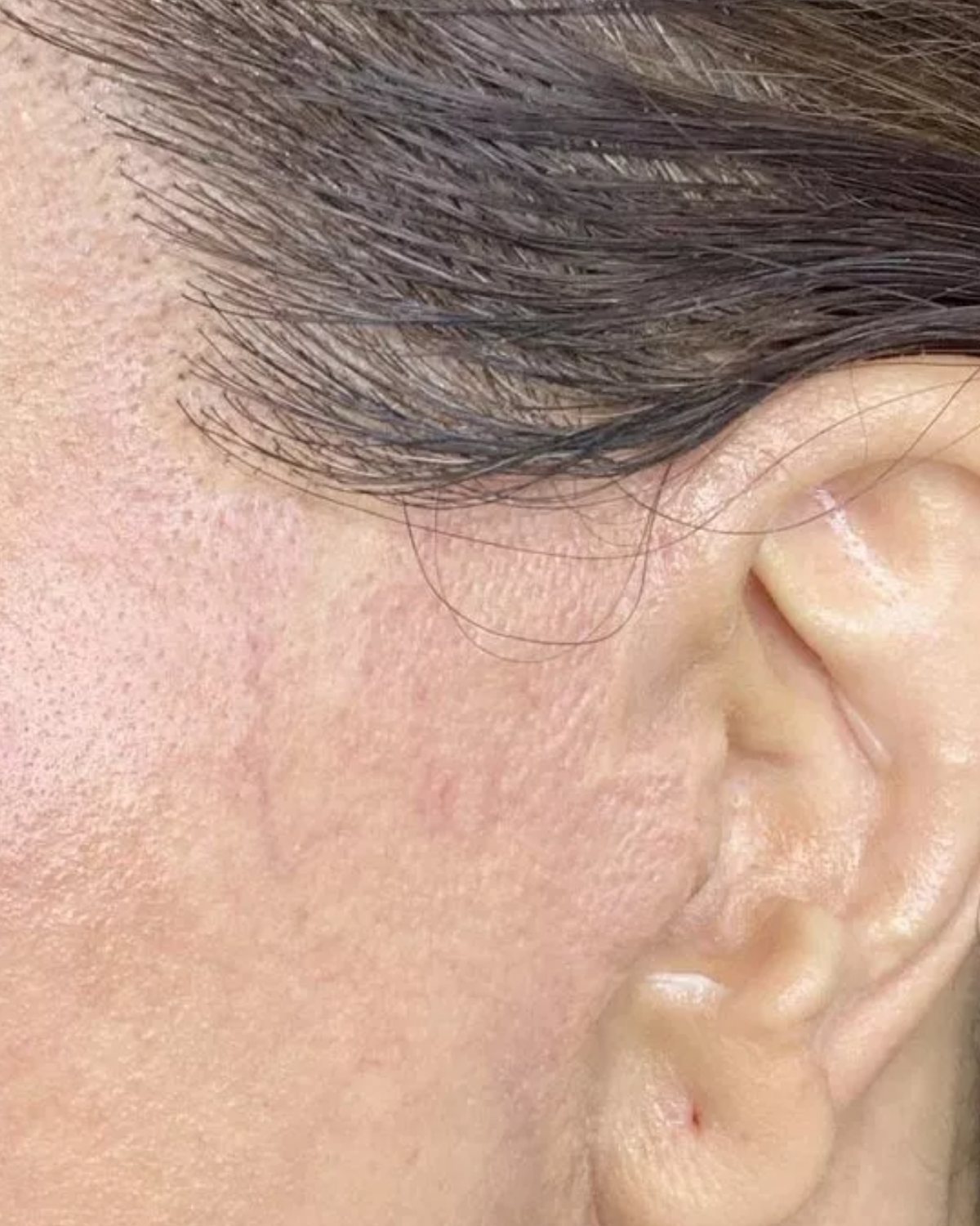 Cicatrice de lifting devant l'oreille, après dermopigmentation