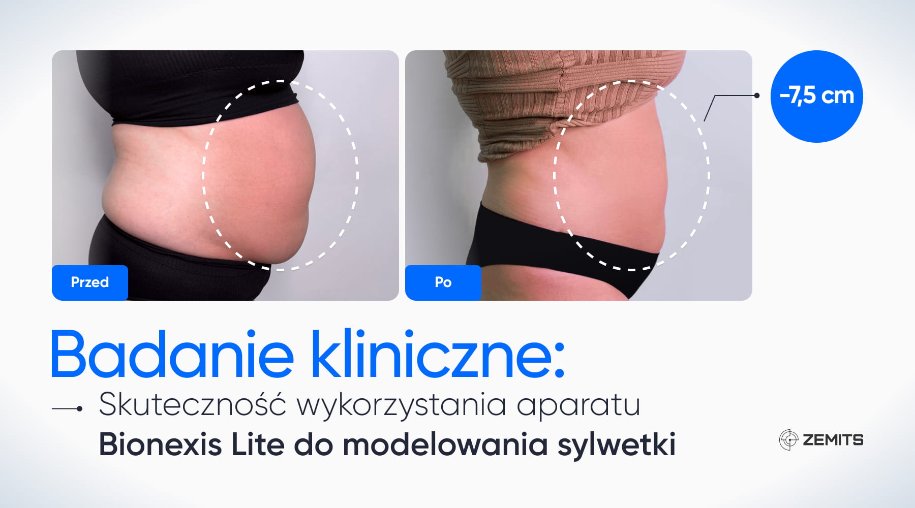 Badanie kliniczne Bionexis Lite – przed i po