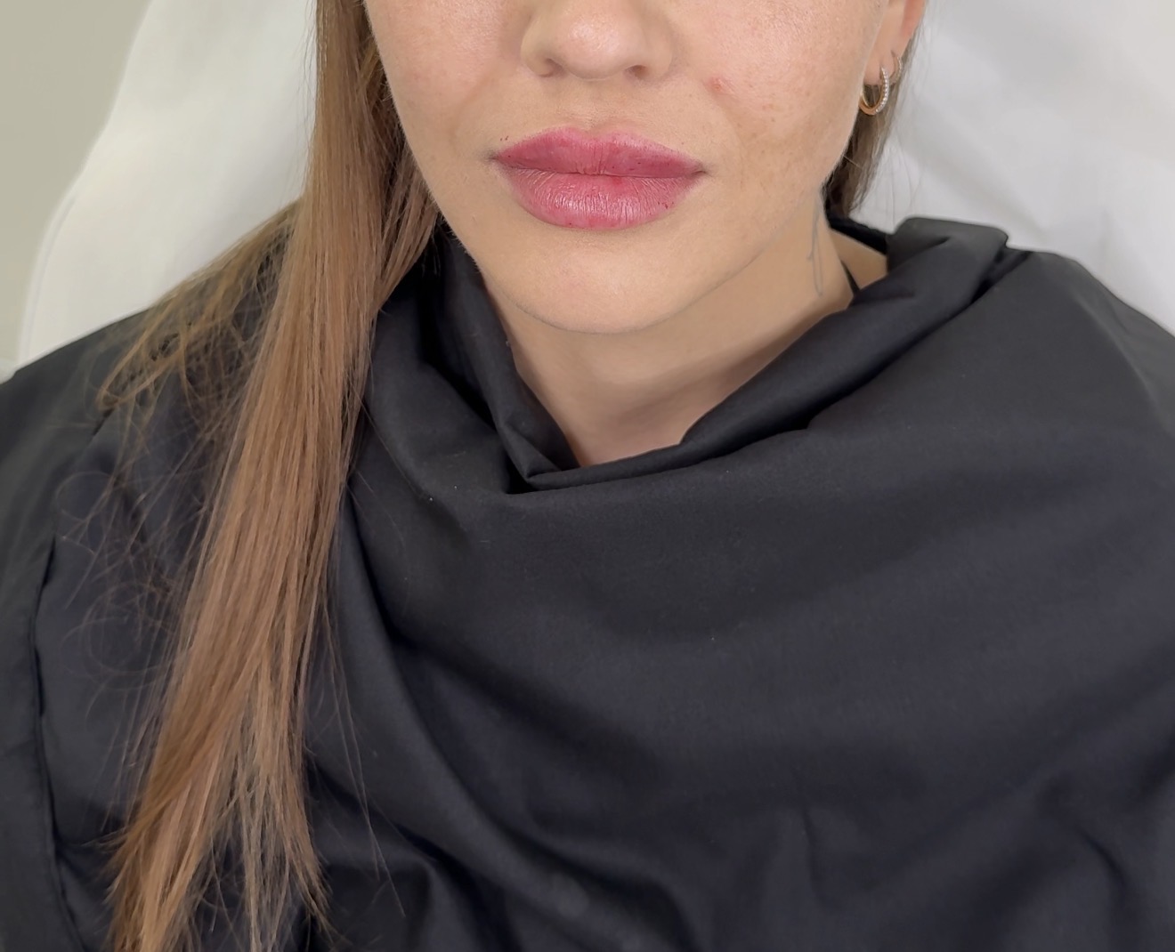 Facial Balancing After