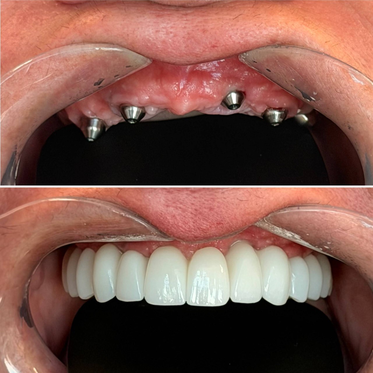 Dental implant before after smile