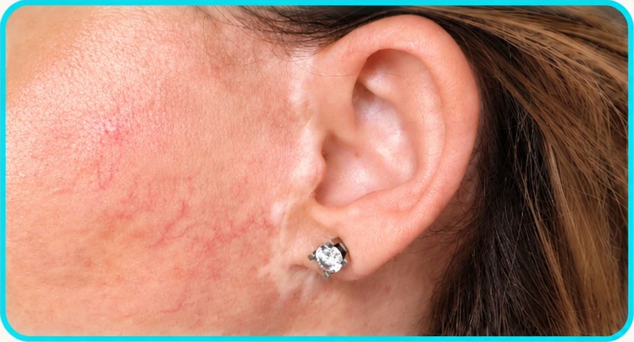 Cicatrice pré-auriculaire après lifting, vue d’ensemble de la joue et de l’oreille
