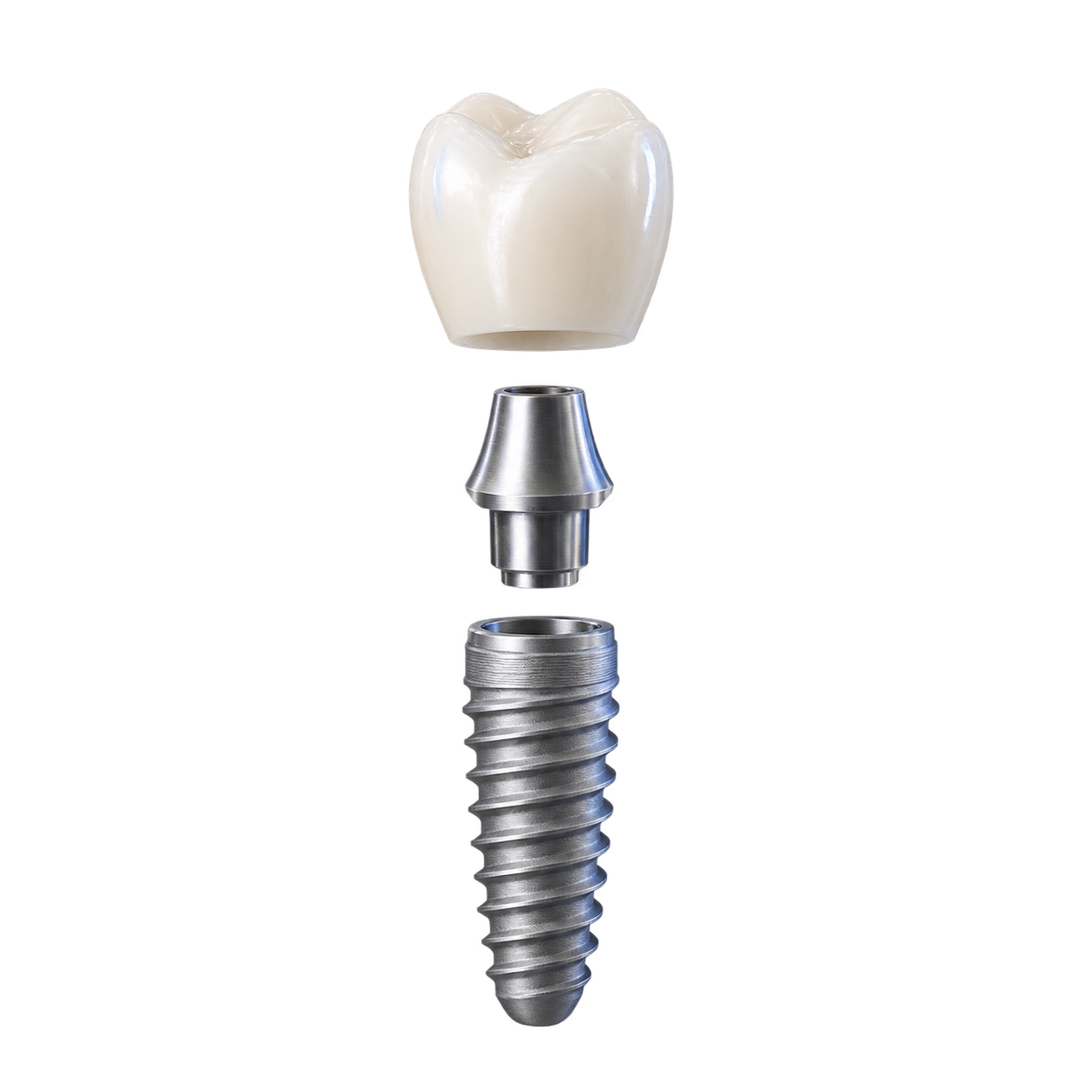 Componentele unui implant dentar: coroană, bont și implant