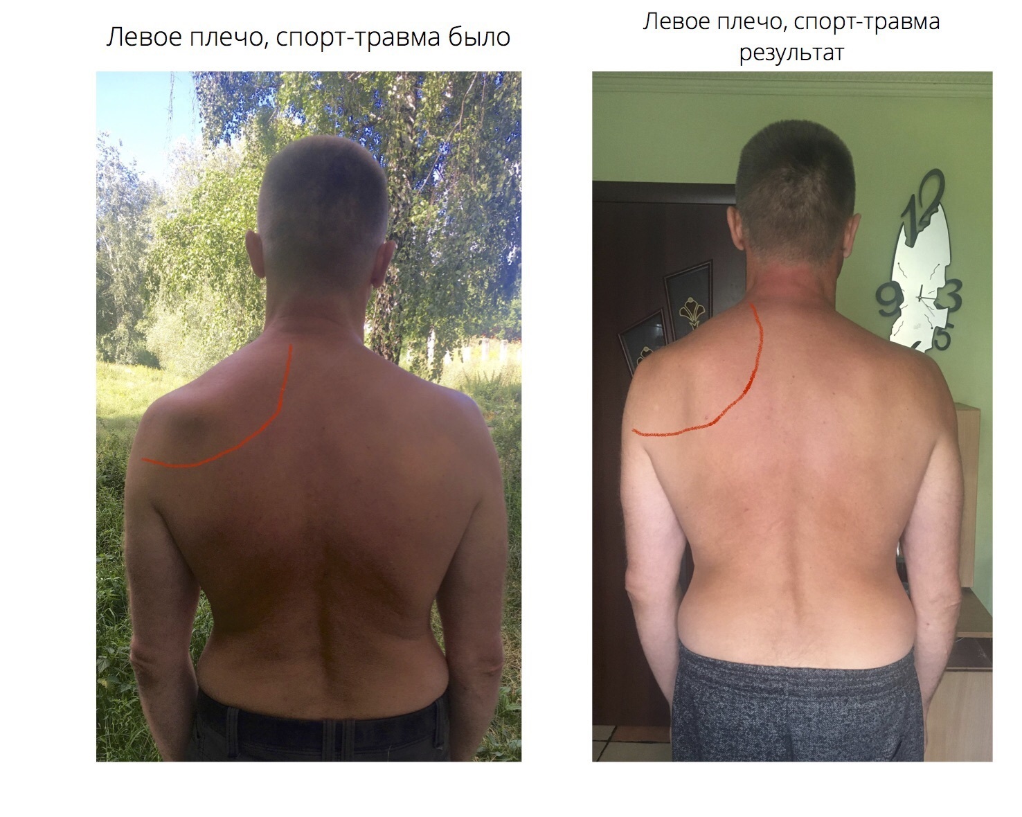 Левое плечо, спортивная травма, до и после