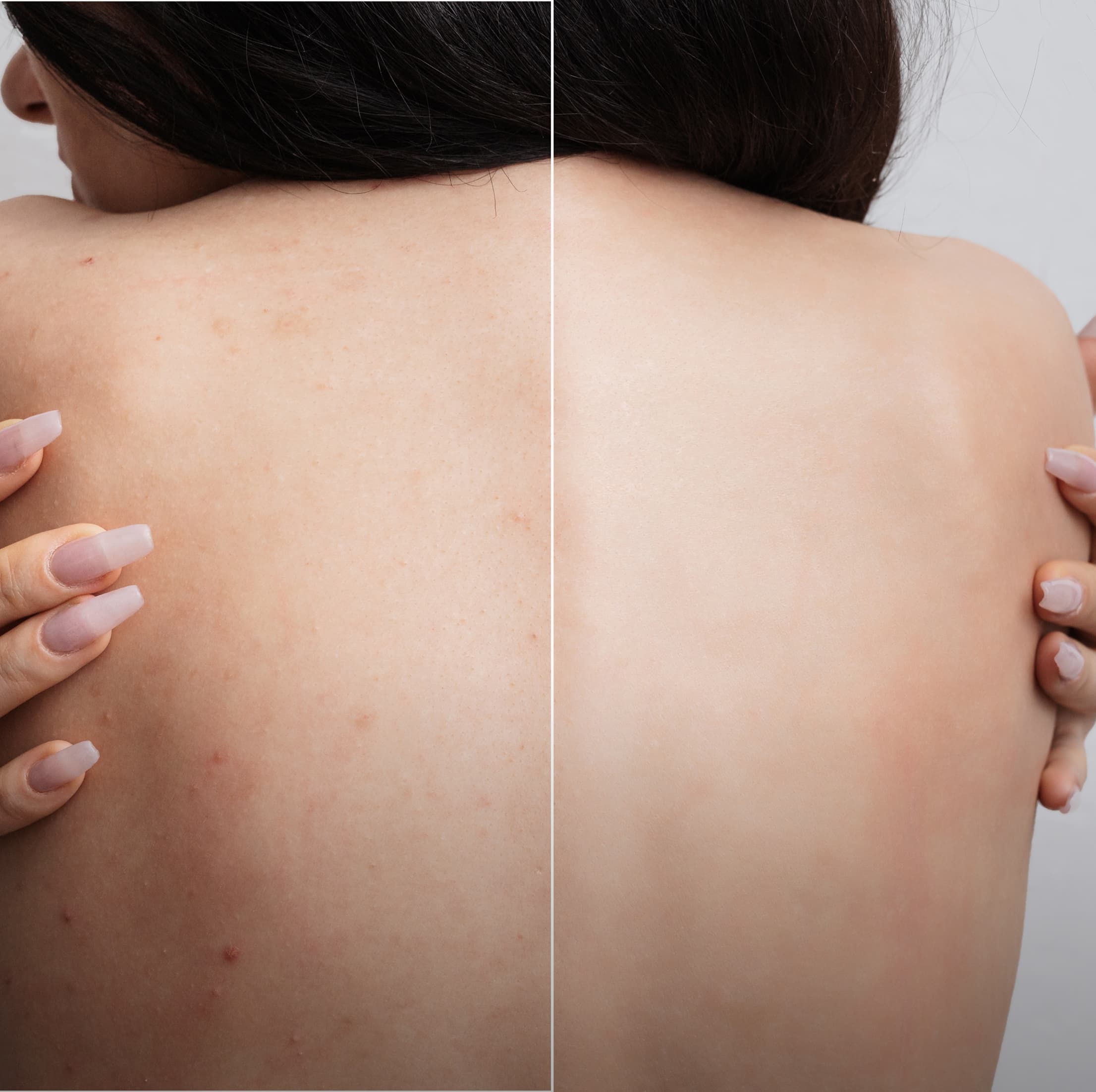 Back Facial treatment in Burbank at NewSkinLA skincare studio