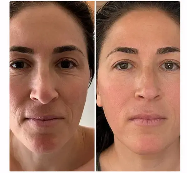 Before and after — Sculptural Face Lifting
