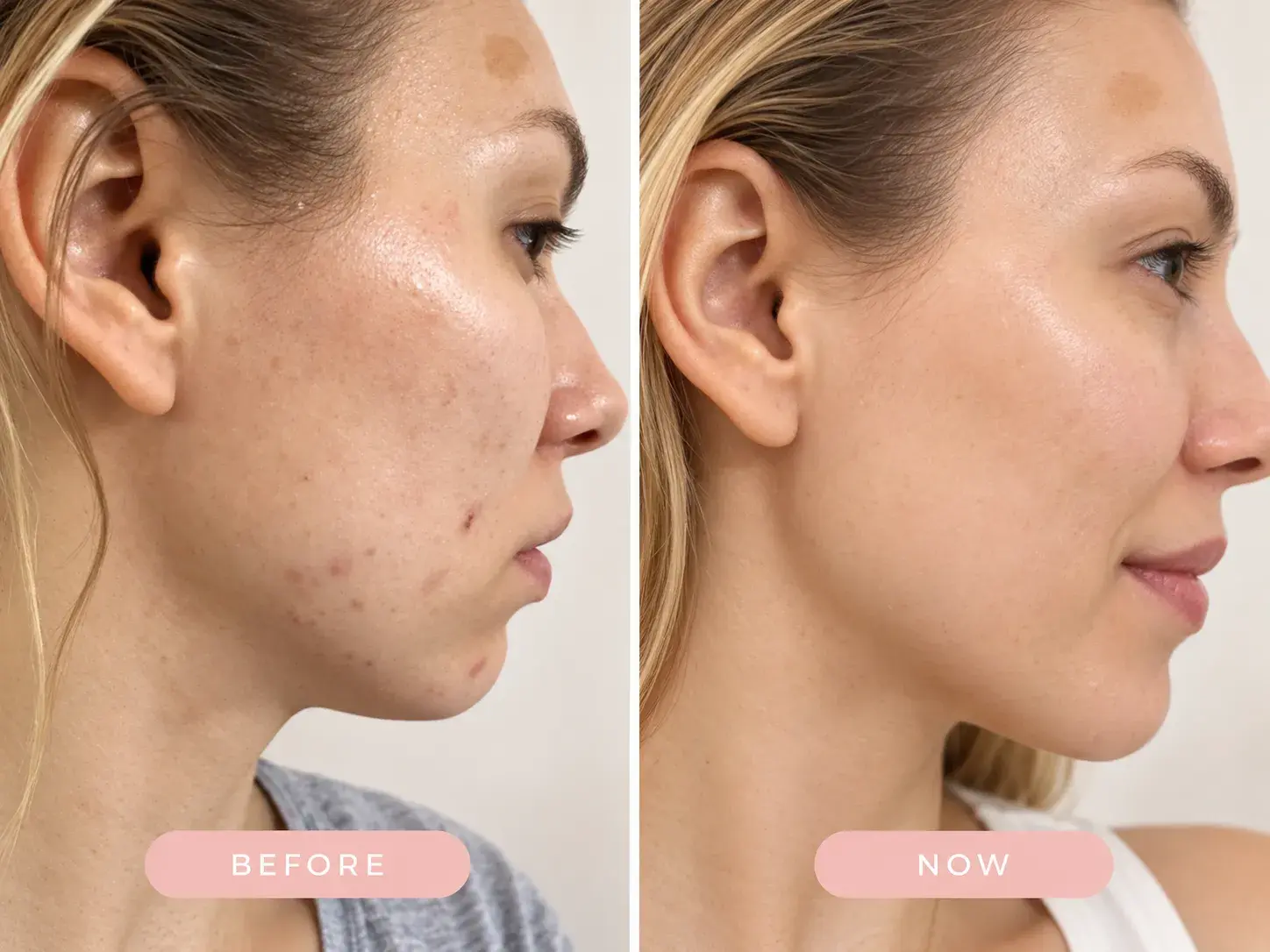 Anna Griffin's personal skin journey before and now