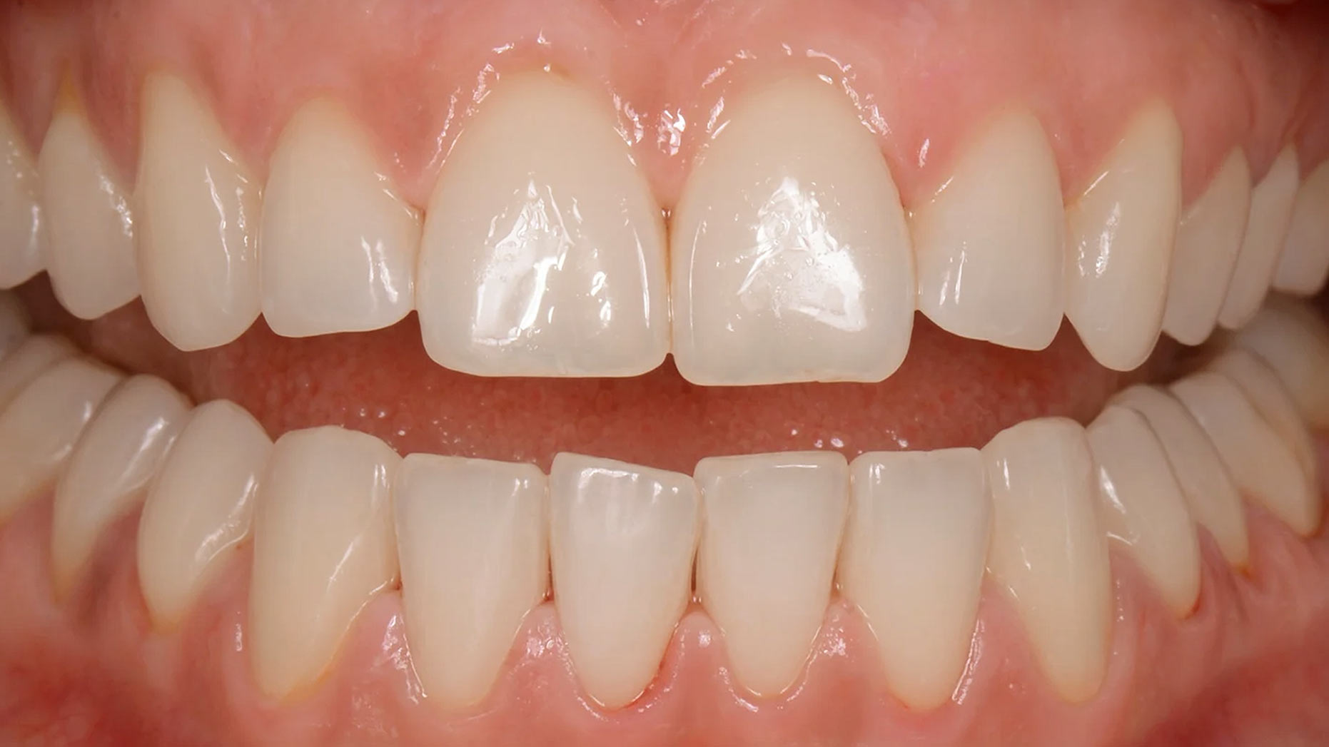 Teeth after GBT treatment
