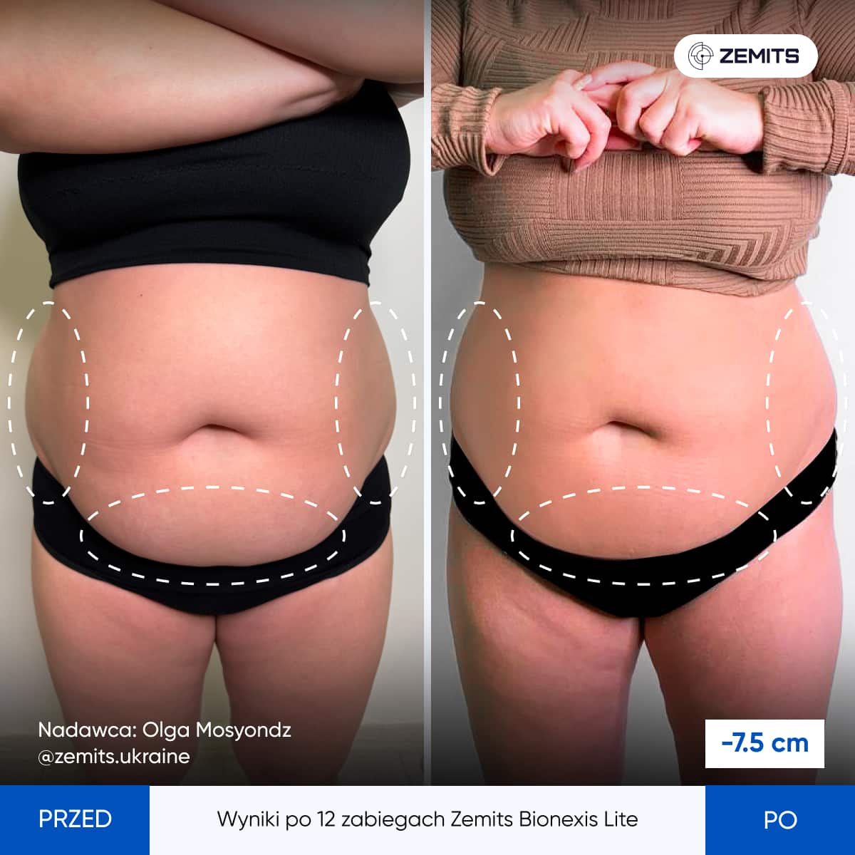 Rezultaty zabiegów Bionexis Lite