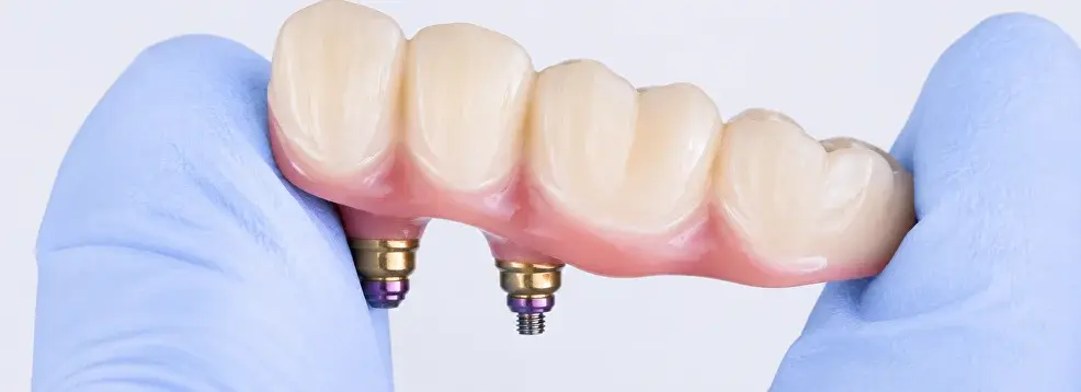 Implant-Supported Bridge