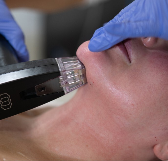 Microneedling Behandlung bei AFACIAL