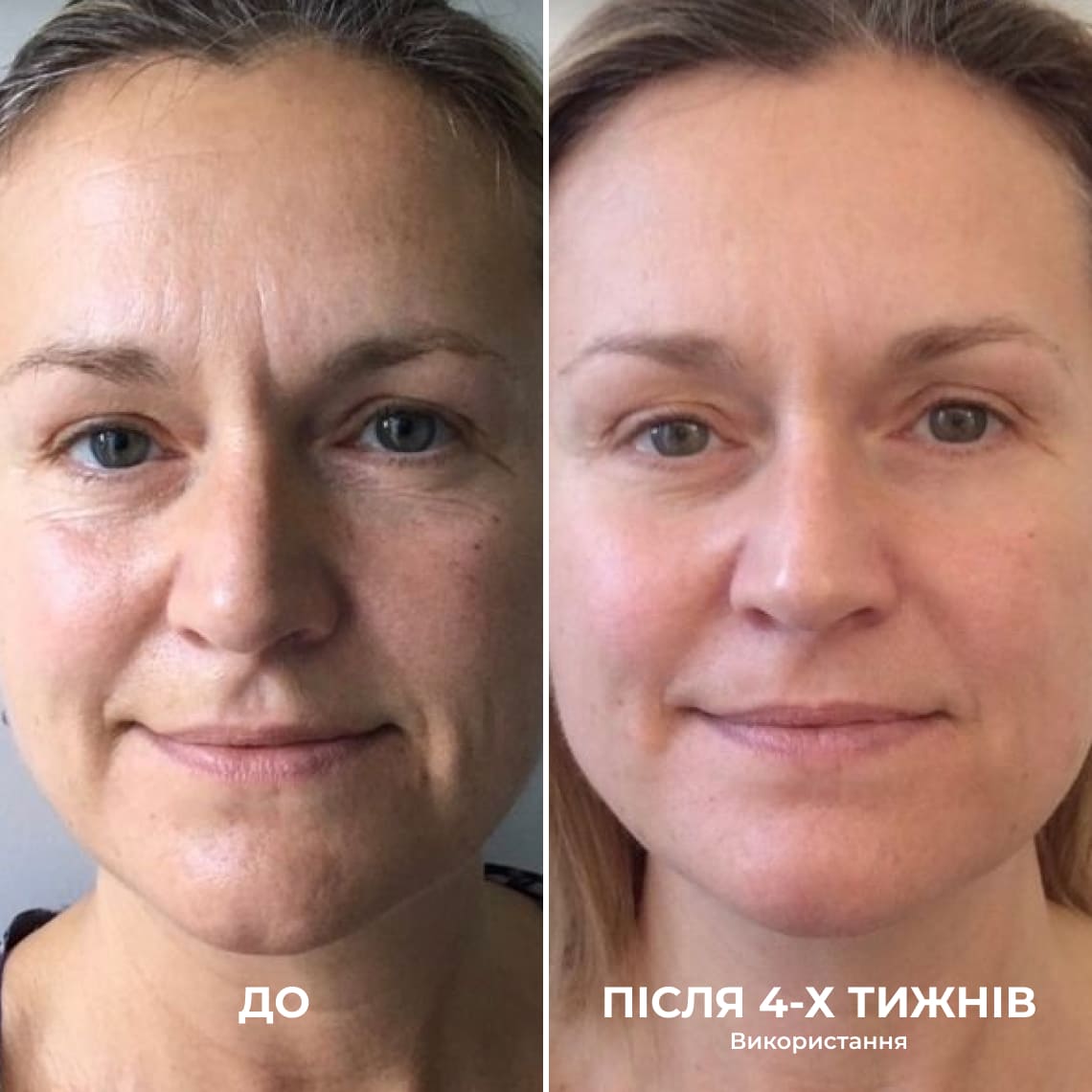 До і після 4 тижнів застосування — шия та підборіддя, фото 2
